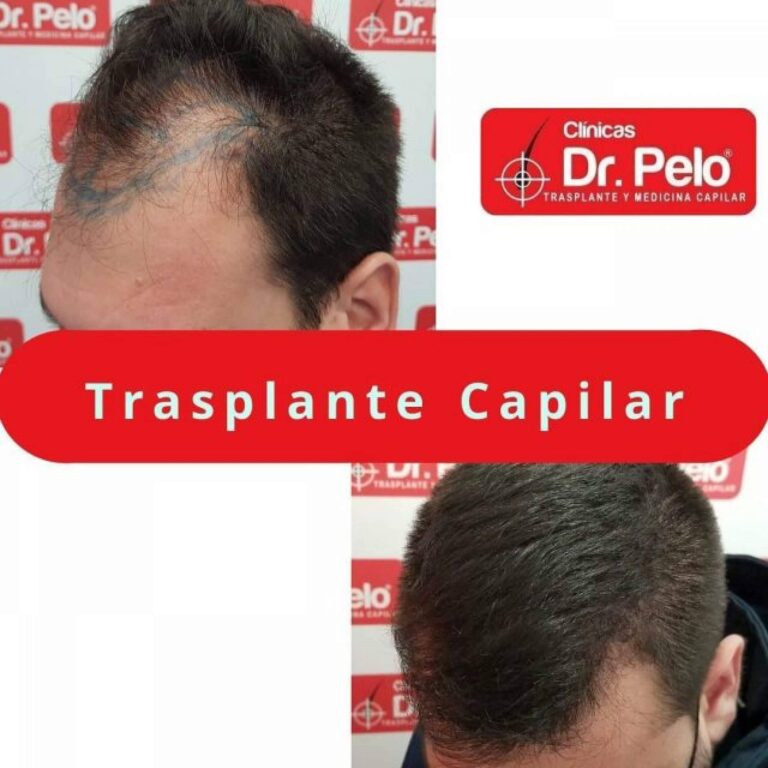 Frenar las entradas en el pelo gracias a los tratamientos de las Clínicas Dr. Pelo