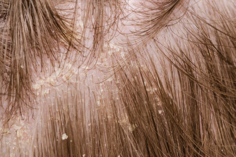 ¿Cómo eliminar las costras en el cuero cabelludo gracias a los productos del Laboratorio Géomer Pure Nature?