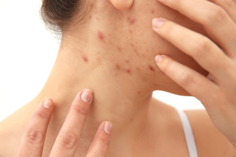 Eliminar el acné y espinillas es posible con AcnéXero. tecnología al cuidado de la piel