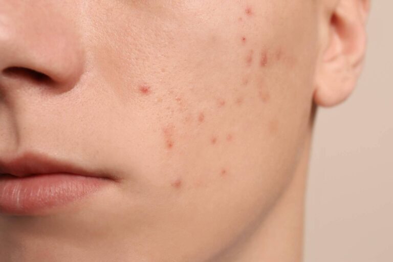 Terminar con las espinillas y el acné es posible actualmente gracias a AcnéXero, una app de inteligencia artificial fundada por dos dermatólogos