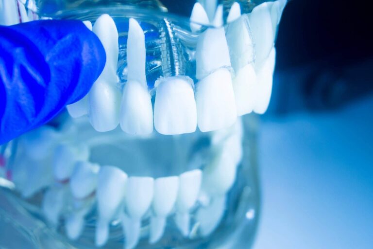 La Clínica dental especializada Artydents en Madrid ofrece tener los dientes fijos en un día