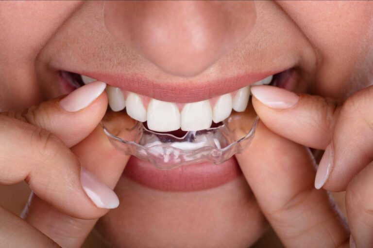 Ortodoncia invisible, la ventaja de elegir Smile Aligner