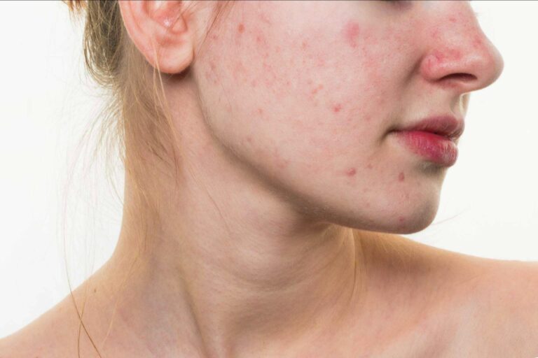 AcnéXero, la aplicación ideada por dermatólogos que propone soluciones efectivas para eliminar el acné