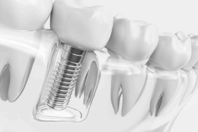 Grupo Gente Vital asegura la calidad de sus tratamientos de ortodoncia invisible