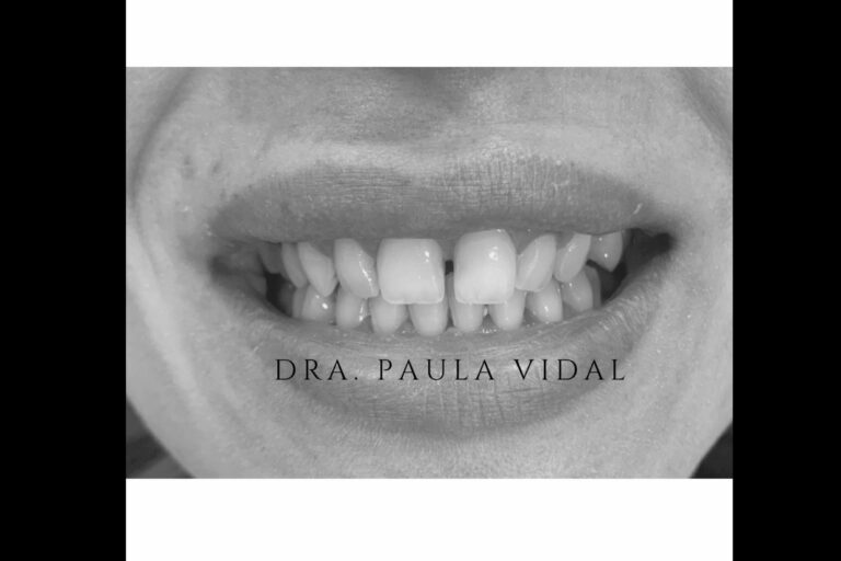 En la Clínica Paula Vidal disponen de un servicio de carillas dentales