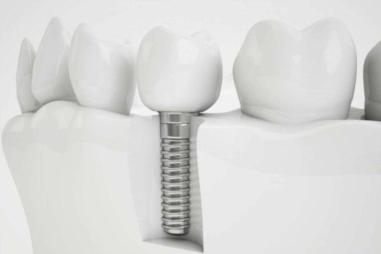 Los implantes dentales que ofrece Grupo Gente Vital