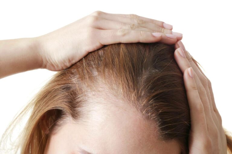 Las mujeres también pueden sufrir alopecia, por Clínica Femme