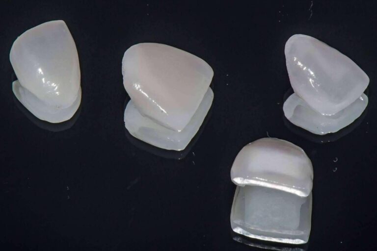Uno de los mejores tratamientos para mejorar la estética dental son las carillas dentales de porcelana