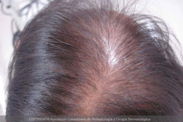 Tipos de alopecia femenina y métodos para combatirla, por Injermur