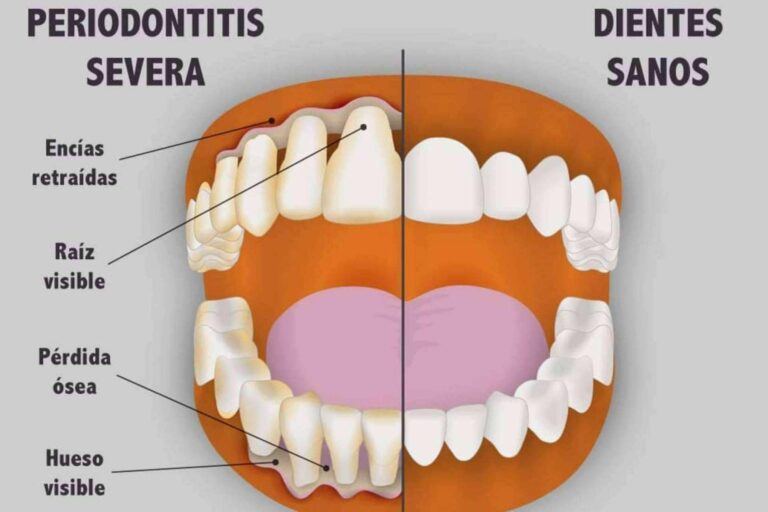 ¿Qué es y cómo tratar una enfermedad periodontal?, por Implant Clinics