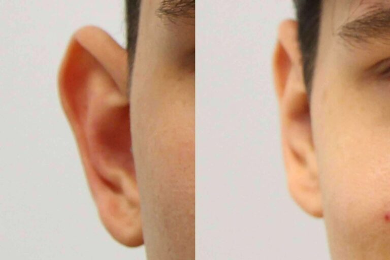 Todo lo que hay que saber sobre la cirugía de orejas