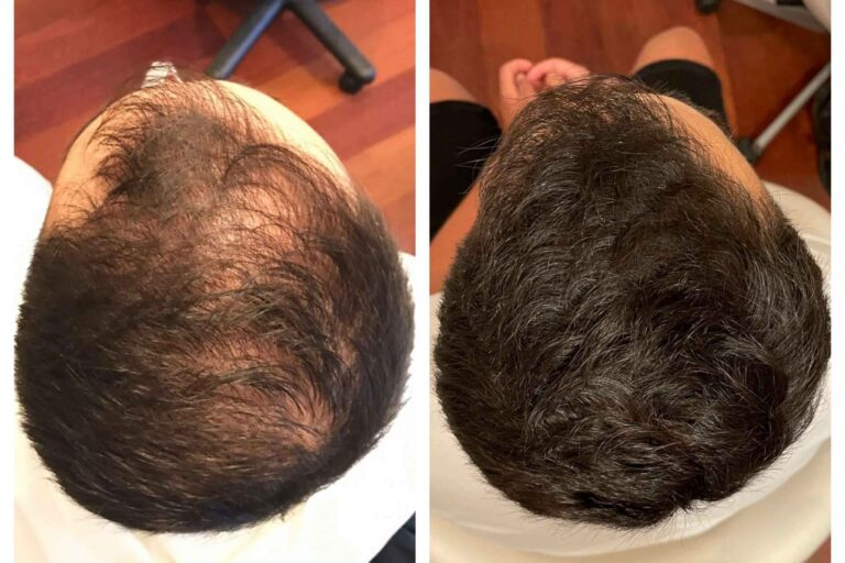 Tratar la alopecia con infiltraciones dutasteride, de la mano de la clínica dermatológica De Felipe