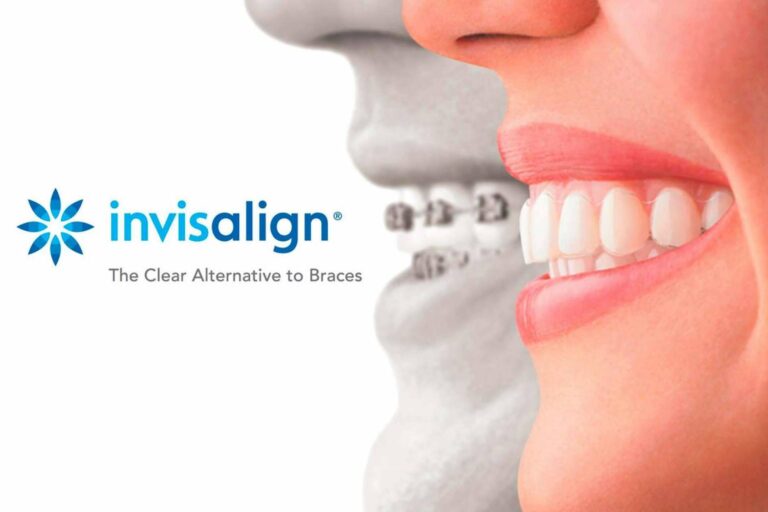 La ortodoncia invisible Invisalign es el sustituto perfecto a los brackets