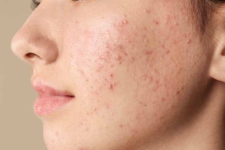 Clínica Tarrazo ayuda a combatir el acné