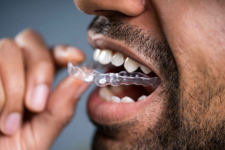 Clínicas Dental Bell habla sobre las ventajas de la ortodoncia invisible