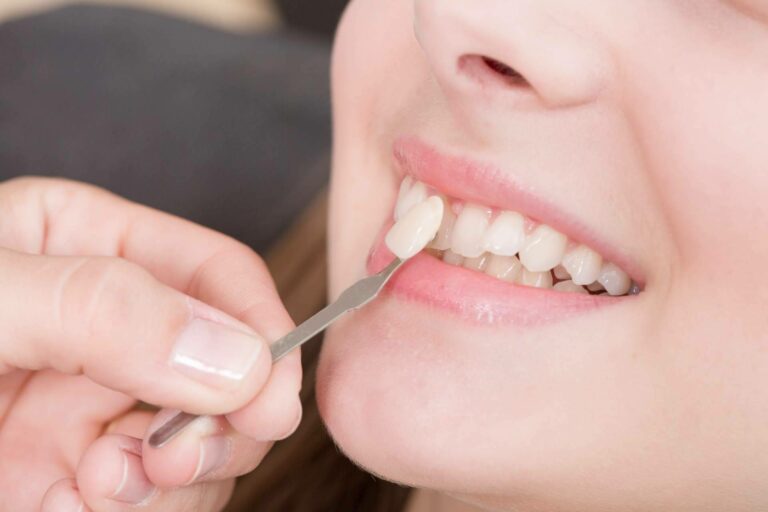 Mejorar la sonrisa de los pacientes con carillas dentales, Clínica Dental Delgado