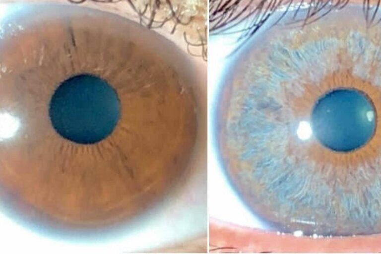 Los avances en las operaciones de cambio de color de ojos con láser, con Clínica Eyecos