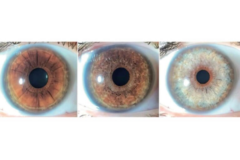 Clínica Eyecos expone que los productos crece pestañas pueden ocasionar un oscurecimiento de los ojos