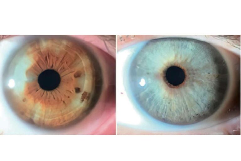 Los heterocromías y los nevus del iris pueden ser tratados con láser según Clínica Eyecos