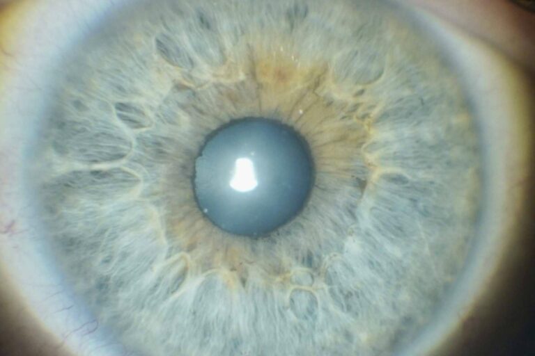 La revolucionaria iridoplastia láser de la Clínica Eyecos. Realizarse el cambio de color de ojos seguro, efectivo y natural