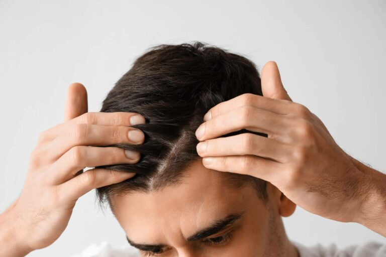 Xpecia hombre, un tratamiento para combatir la alopecia