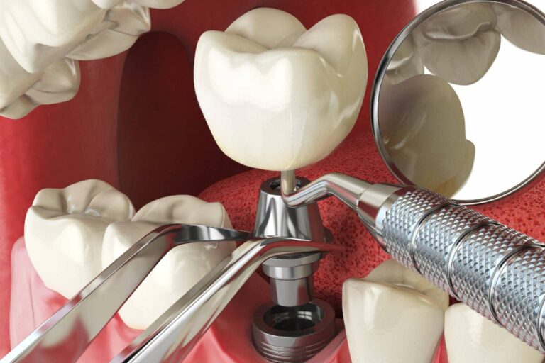 Descubrir el estándar de calidad en implantes dentales de Denty Dent en Madrid